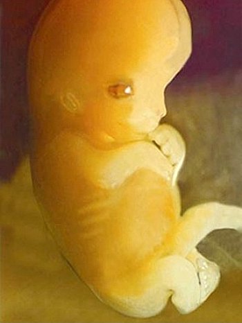 Abtreibung Kind